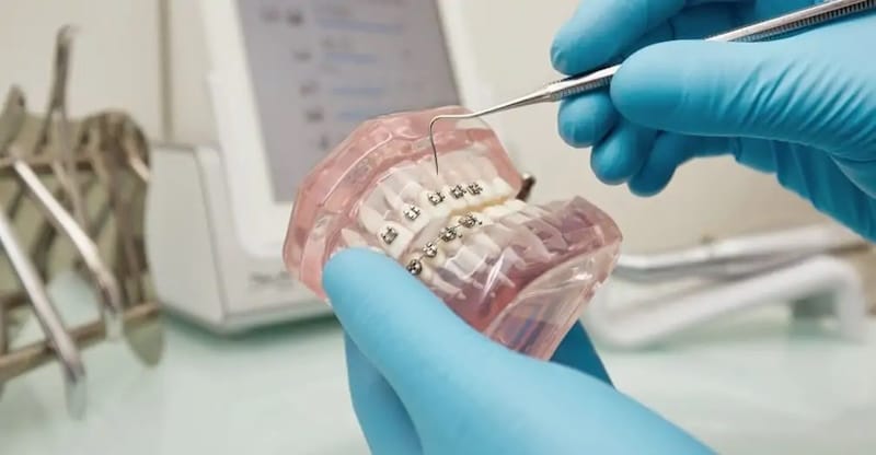 Скільки коштує встановлення брекетів